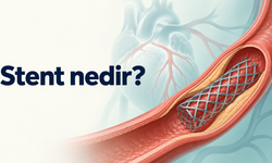 Stent nedir?